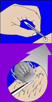 [illustration showing proper tick removal]